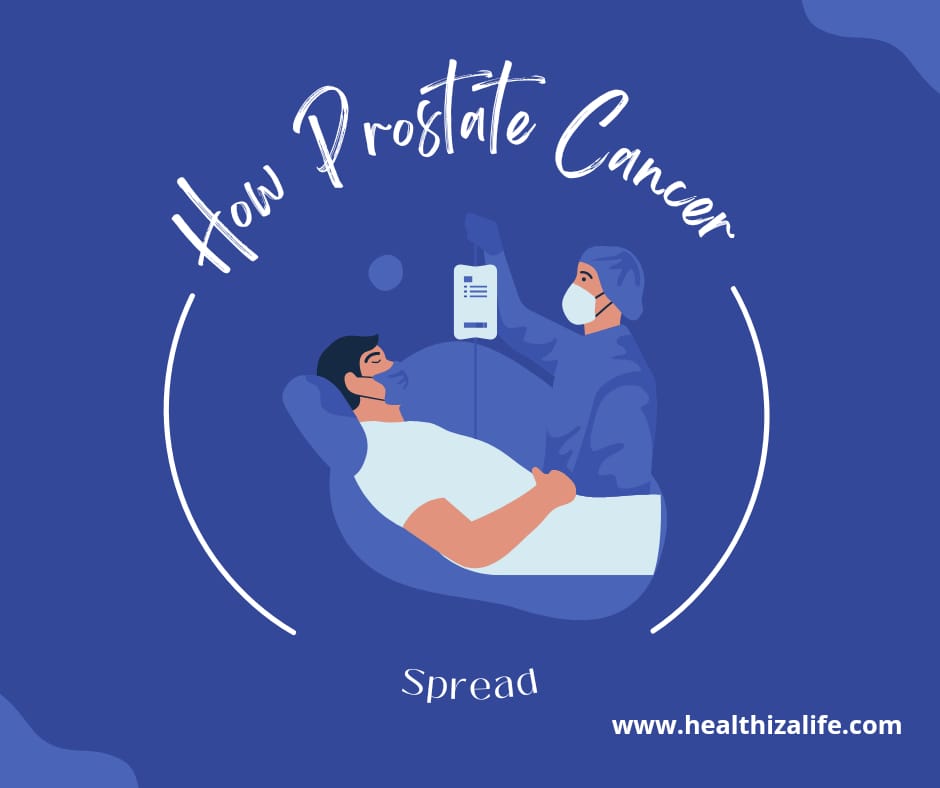 How Prostate Cancer Spreads