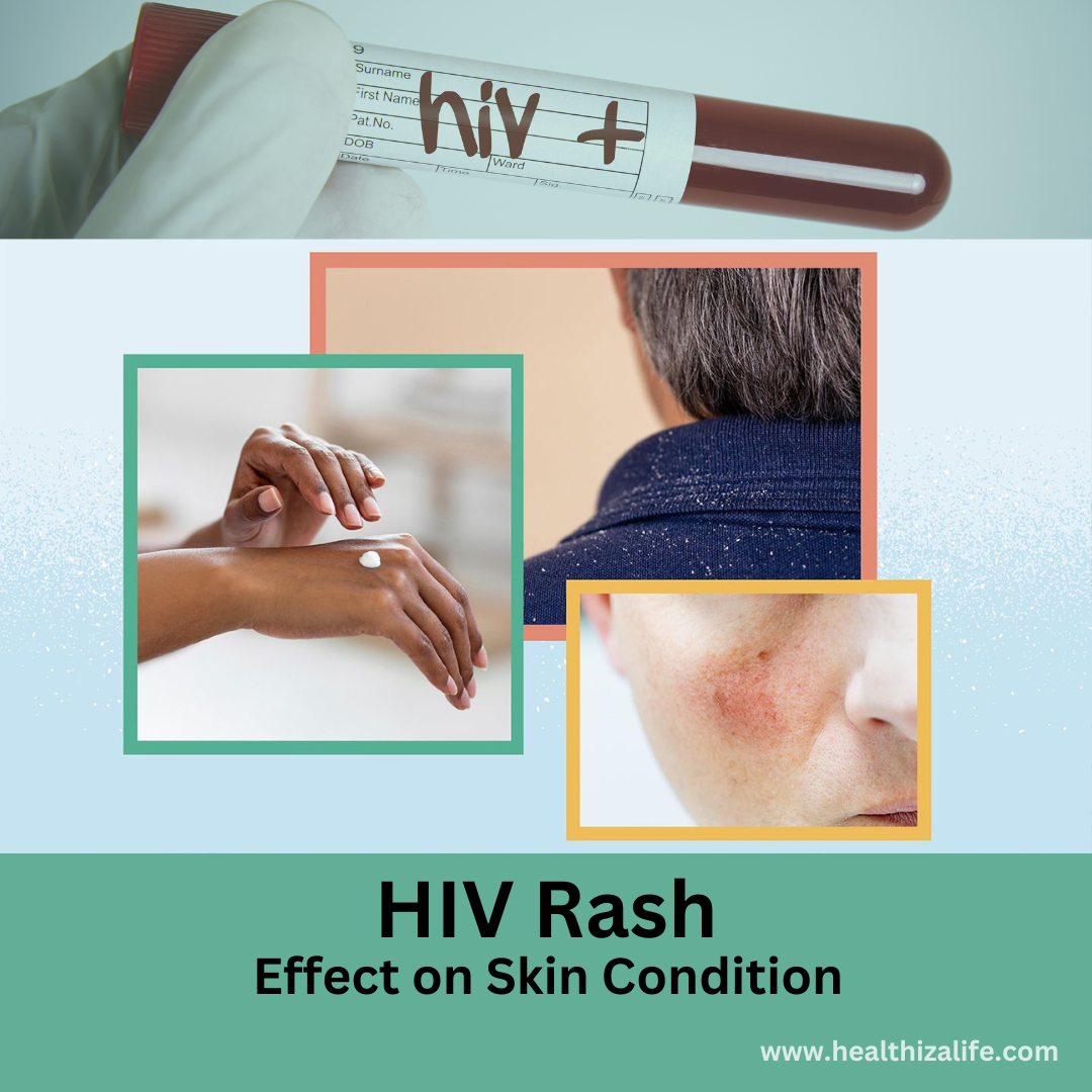 Hiv Rash & Its Symptoms